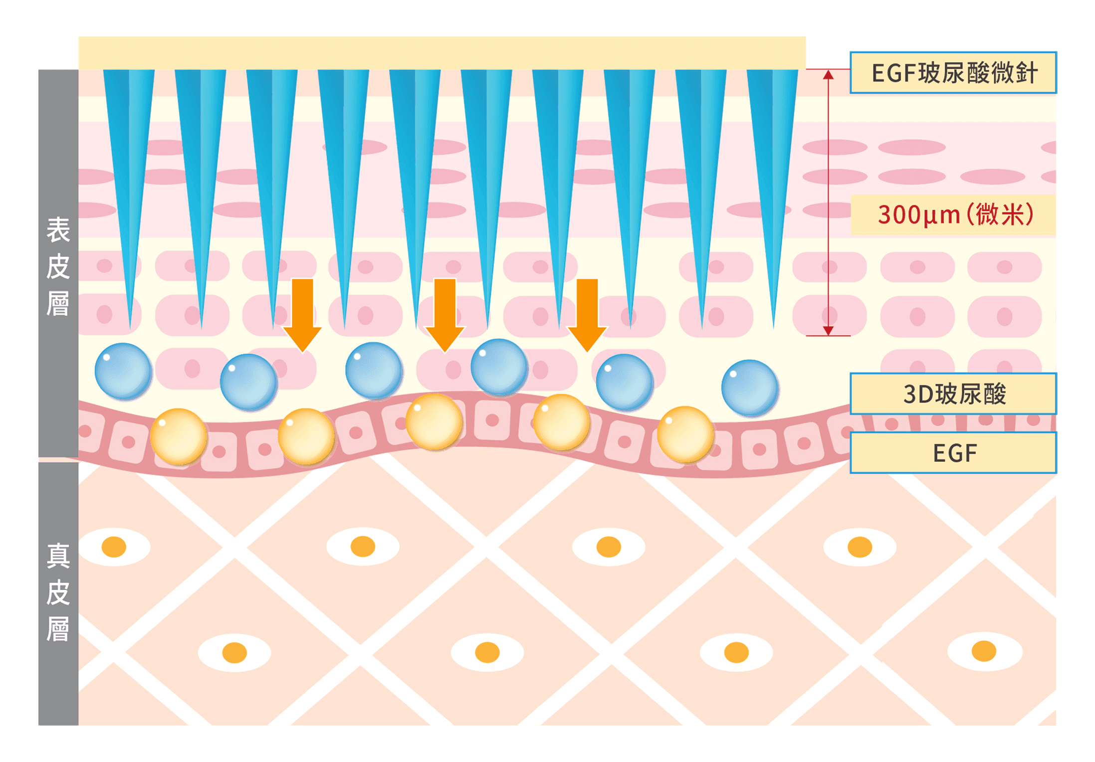 EGF玻尿酸微針圖